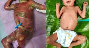 सुदूर बीजापुर में चिकित्सा चमत्कार : अत्यंत दुर्लभ बीमारी से जूझते शिशु को बचाया….