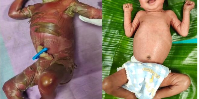सुदूर बीजापुर में चिकित्सा चमत्कार : अत्यंत दुर्लभ बीमारी से जूझते शिशु को बचाया….
